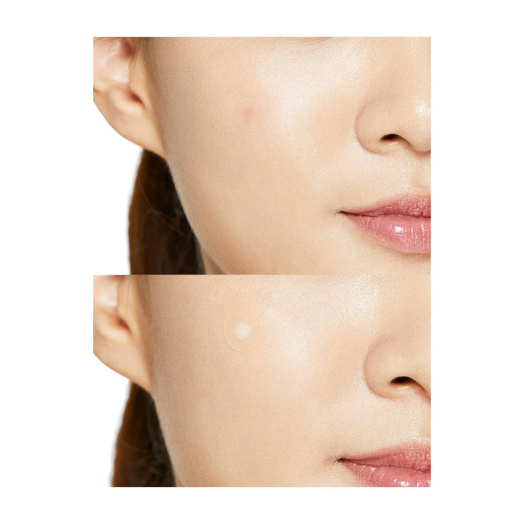 Cosrx Acne Pimple Master Patch (Pack Of 24) - Image 2