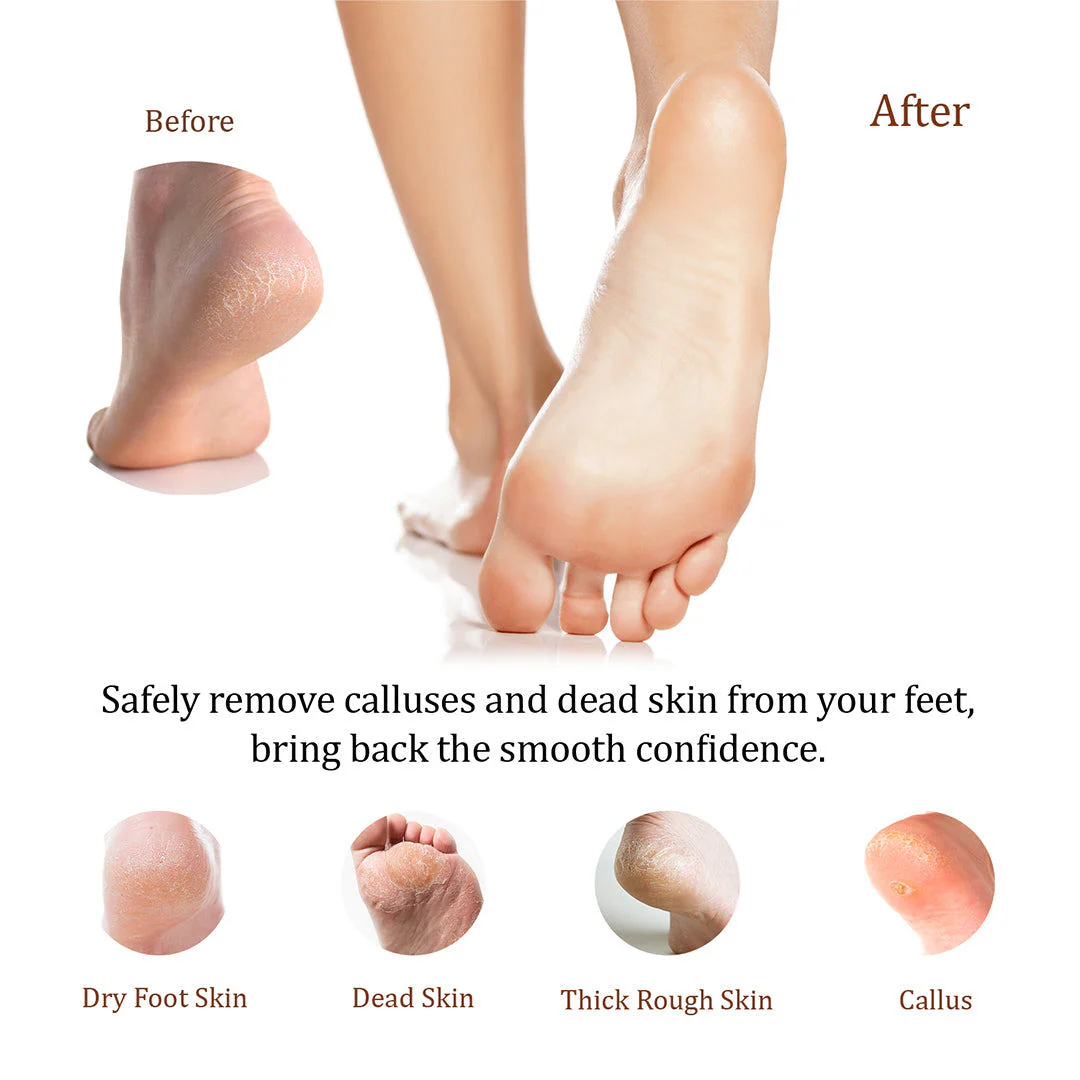 KDS Natural Feet Callus Remover 1Gal (Case of 4) - Image 2